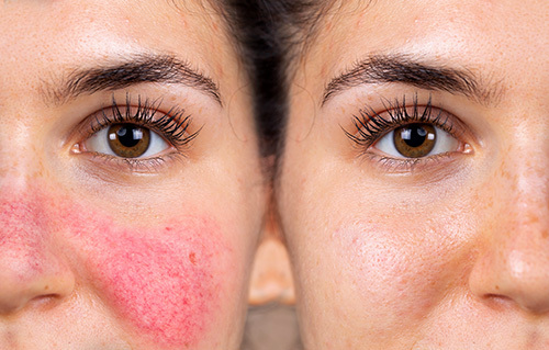 Side-by-side image showing rosacea flaring up and the same woman with clear skin